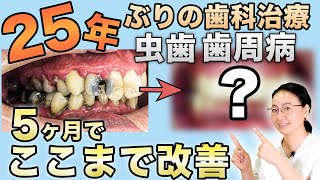 25年ぶりの歯科治療🦷虫歯歯周病【5ヶ月】でここまで改善✨🤩👍First dental treatment in 25 years Bad oral health improve by 5 mo [upl. by Nageam]