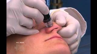 Dr Rebecca Fitzgerald Shows How SilkPeel takes years of the face [upl. by Nnaasil699]