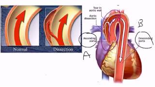 Aortic Dissection [upl. by Eltsyrk]