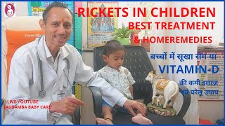 RICKETS IN CHILDREN BEST TREATMENT amp HOMEREMEDIESबच्चों में सूखा रोग VITAMIN D की कमी इलाज़ नुस्खे [upl. by Gonnella]