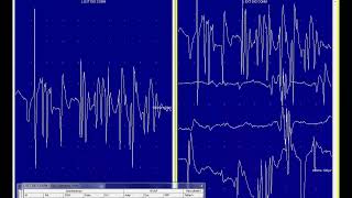 myotonic discharges [upl. by Fennell373]