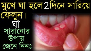 মুখের ঘা দূর করার উপায়mukhe gha hole ki korboমুখে ঘা হলে কি করবেনমুখের ঘা সারানোর উপায়। [upl. by Gualtiero159]