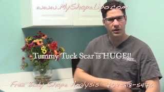 Liposuction vs Tummy Tuck Do I need a Liposuction or Tummy Tuck [upl. by Negiam692]