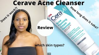 Watch This Before You Buy Cerave Acne Foaming Cream Cleanser Review⎜On Oily Acne prone Skin [upl. by Cohin]