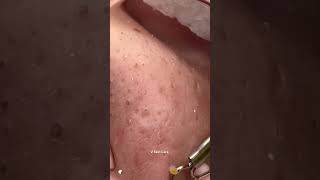 Remove ACNE FAST With These Treatment Secrets dermatologia acne blackheads [upl. by Sundin]