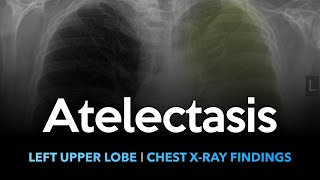 Atelectasis Left Upper Lobe Explanation of Chest Xray Findings [upl. by Heiner]