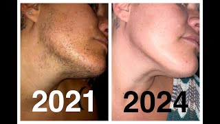 Results after 161 Hours of Electrolysis facial hair removal PCOS Hirsutism Excess Hair [upl. by Mutat119]