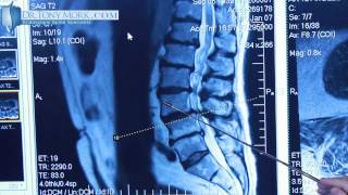 Degenerative Spondylolisthesis by Dr Tony Mork [upl. by Eidob37]