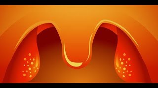 Normal tonsils vs swolleninflammed tonsils PicturesImages [upl. by Attalie]