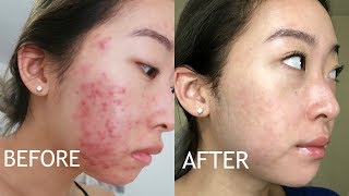 MY 5 MONTH ACCUTANE JOURNEY  SIDE EFFECTS PROGRESS PICS REGRETS [upl. by Meer]