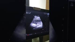 Kidney ultrasound  Ultrasound KUB  Pyonephrosis [upl. by Klayman]