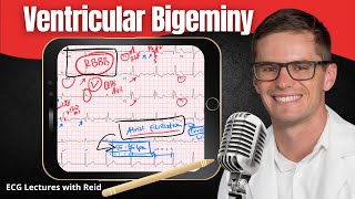 Ventricular Bigeminy EKG  ECG Lecture [upl. by Keon142]