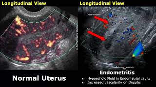 Uterus amp Adnexa Ultrasound Normal Vs Pelvic Inflammatory Disease PID Images  Gynecological USG [upl. by Adnoryt]