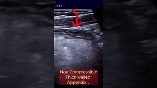 When Appendix becomes Infected and Complicated ultrasound appendicitis intestine [upl. by Yleek790]