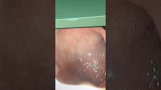 Upper endoscopy of a child with persistent vomiting one year ago showing gastritis and duodenitis [upl. by Nylrac]