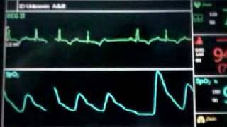 ECG Video AV Block  Second Degree Type 1 Wenckebach  video2 [upl. by Navar]