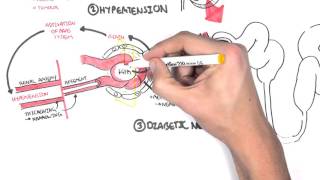 Chronic Kidney Disease CKD Pathophysiology [upl. by Drhacir]