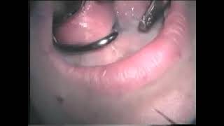 Dental laser treatment video 3 [upl. by Yared]