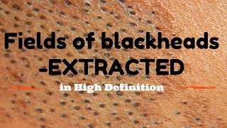 Blackhead fields extractions in HD [upl. by Monto144]