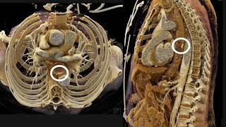 CT Evaluation of GI Bleeding Part 1 [upl. by Ashil]