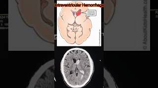 Intravascular hemorrhage  CT scan of brain  Brain hemorrhage shorts shortsfeed viralshort [upl. by Wadleigh367]