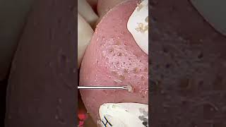 Skincare  Blackheads Removal 174 skincare skincare blackheads blackheads [upl. by Lertnek]