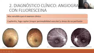 VASCULITIS RETINIANAS EN ENFERMEDADES AUTOINMUNES  DRA VALERY ASCUÑA [upl. by Marti42]