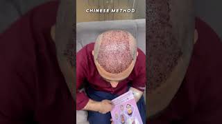 Chinese Method 8000 Grafts before amp after result of hair transplant 😎👍 [upl. by Pease]