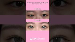 Droopy eyes correction ptosis shorts ptosis beforeandafter [upl. by Alorac451]