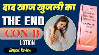 Khujli Ka The End  Clotrimazole With Beclomethasone Lotion  Fungal Infection Lotion  Con B Review [upl. by Ahsinyar]