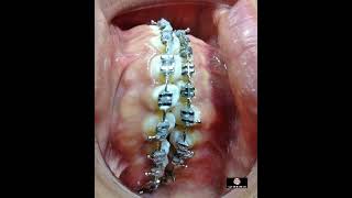 ortho talk update on a torque premolar with lingual botton and close spring coil helped moved [upl. by Palm333]