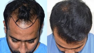 Hair Transplant Results USA Canada UAE  Medispa India JaipurDelhi by Dr Suneet Soni [upl. by Varin]