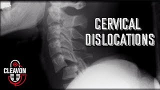 Cleavon MD  Cervical Dislocations [upl. by Godwin]