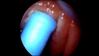 CHIRURGIA ADENOIDI IN ENDOSCOPIA CON RADIOFREQUENZE [upl. by Vyner463]