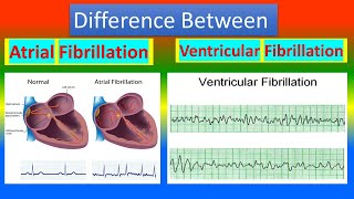 Difference between atrial fibrillation and ventricular fibrillation [upl. by Drarreg]