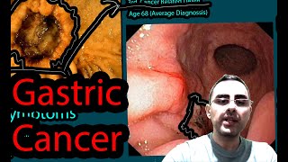 Gastric Cancer  Stomach Cancer why is so Insidious early symptoms causes Treatment [upl. by Toor]