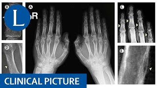 Hyperparathyroidism shows its hand findings of osteitis fibrosa cystica [upl. by Kuehn356]