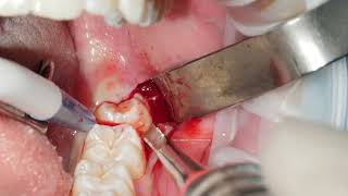 Extraction of a partially erupted 38 wisdom tooth [upl. by Akvir]