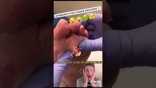 Cystic acne and blackheads removal  Newest pimple pops for 2024 [upl. by Reiko]