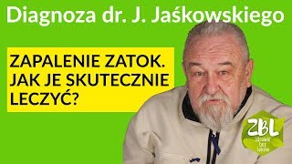 dr Jerzy Jaśkowski  Leczenie zapalenia zatok [upl. by Damali]