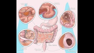 LES OCCLUSION INTESTINALE AIGUE PARTIE 1 [upl. by Nirret940]