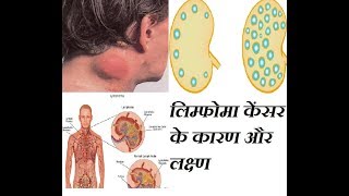 लिम्फोमा केंसर के कारण और लक्ष्ण lymphoma cancer ke kaarn or lakshn [upl. by Jahdal]