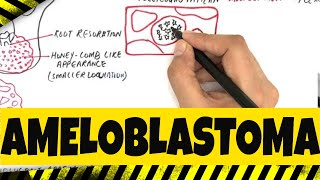 Ameloblastoma  Origination Clinical Radiographic amp Histopathologic features [upl. by Annalla561]