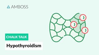 Hypothyroidism A Diagnostic Approach [upl. by Annavas]