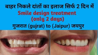 गुजरात gujrat से आये मरीज के बाहर दांतो का इलाज सिर्फ 2 दिन में  Smile design treatment Smile [upl. by Derek862]