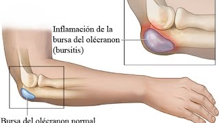 BURSITIS CODO DERRAME ARTICULAR TRATAMIENTO [upl. by Acillegna484]