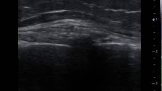 Entrapment of the infrapatellar branch of the Saphenous nerve non affected side [upl. by Brita]