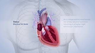 Biotronik pacemaker [upl. by Suiratnauq]