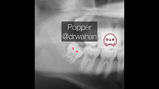 Leverage when Extracting Teeth with Voiceover drwahan [upl. by Iphagenia]