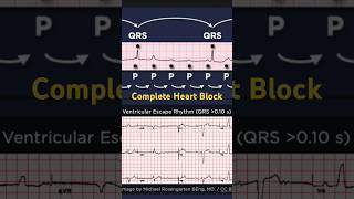 Third Degree Atrioventricular Block ECG Ventricular Escape Rhythm [upl. by Leaw]